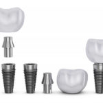 インプラントで使用されるパーツ