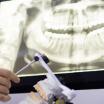 インプラントの手術方法は