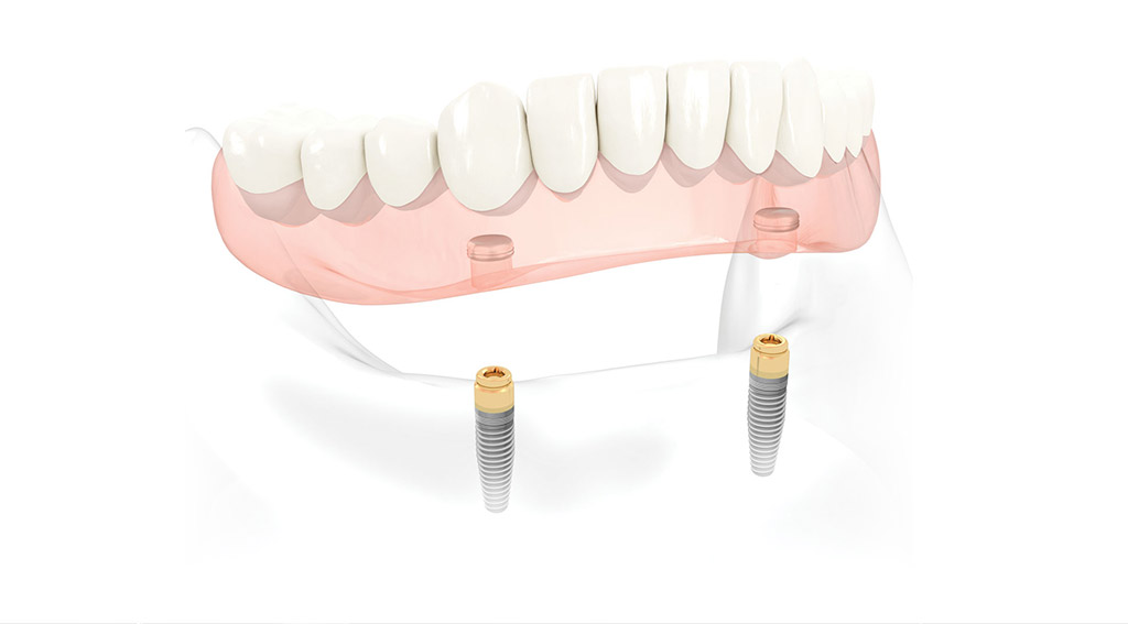 インプラントオーバーデンチャー（義歯・入れ歯）