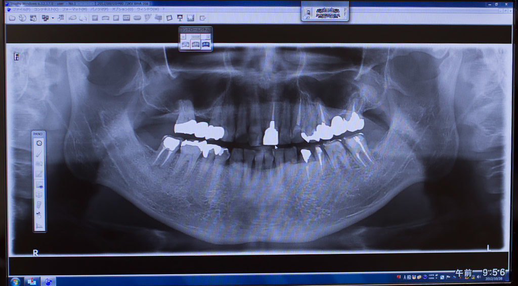インプラント治療の前に治すべき口内の病気