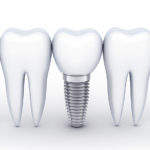 インプラントと骨結合