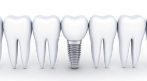 インプラントと骨結合