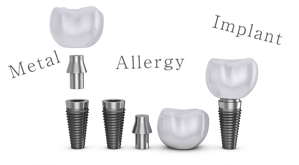 金属アレルギーでもインプラント治療はできる？