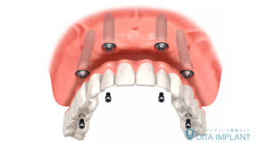 オールオン4治療が向いている人は?