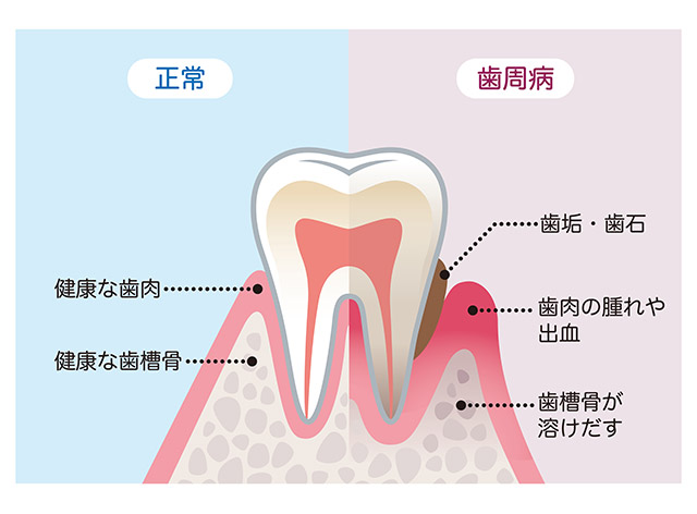 歯周病のリスク