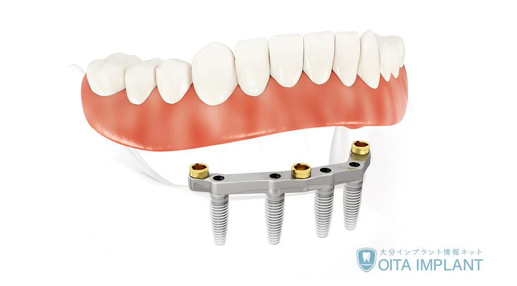 インプラント義歯（入れ歯）とは