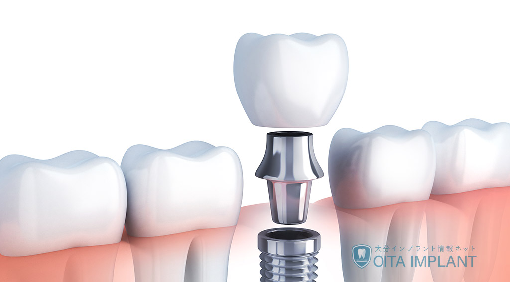 インプラントの上部構造(被せ物、セラミックなど)