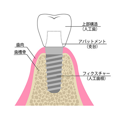 インプラントの構造図