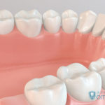 血友病患者の歯科治療