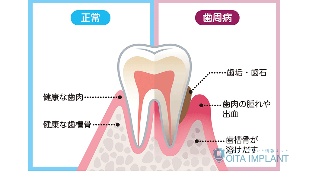 歯石除去