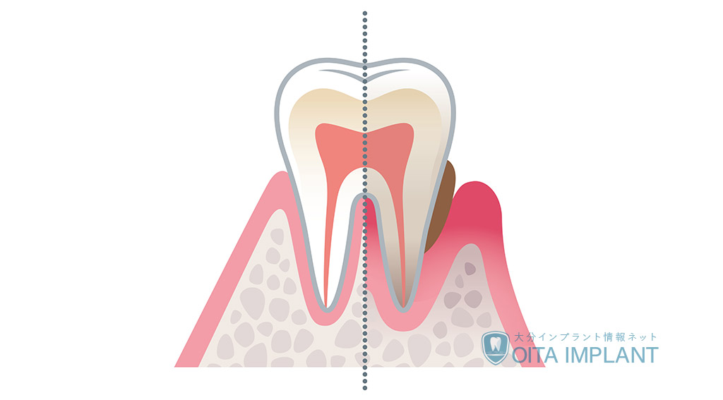 歯の神経を取るとどうなる？