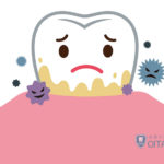 プラーク（歯垢）とは