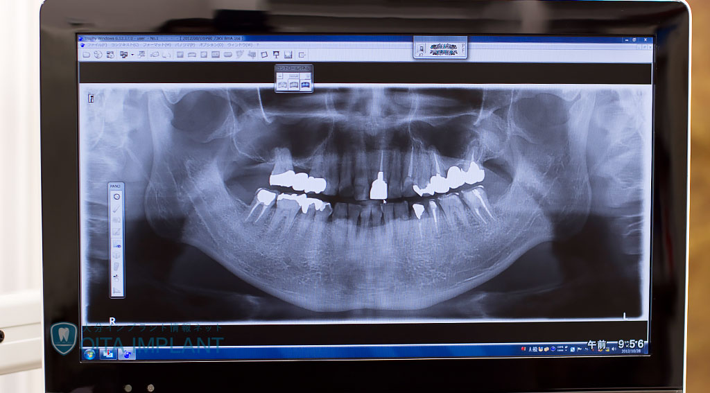 歯科放射線について（X線）