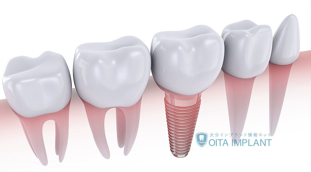インプラントの安全性