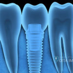 インプラント治療後の注意点