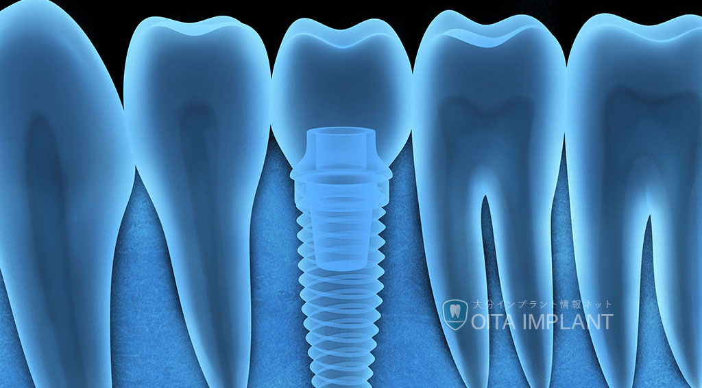インプラント治療後の注意点