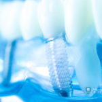 インプラント周囲炎を予防しよう