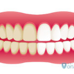 歳をとると歯が黄色くなる?歯が変色する原因