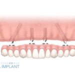 多くの歯をなくした方のためのインプラントオールオン4