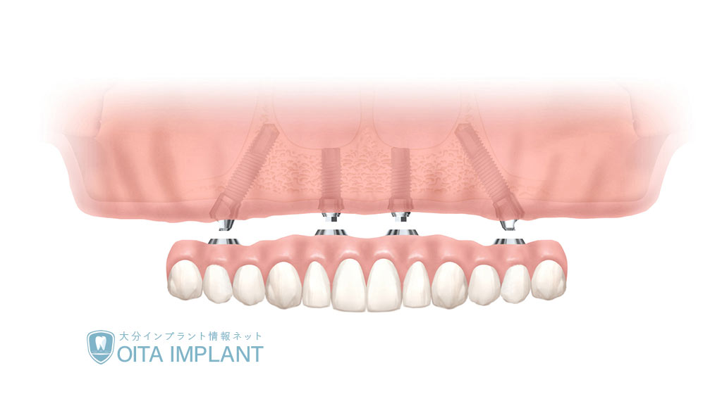 多くの歯をなくした方のためのインプラントオールオン4