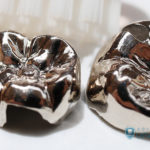 銀歯を白くするには