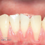 骨再生療法　エムドゲイン