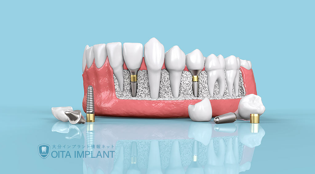 インプラントのオーバーホール