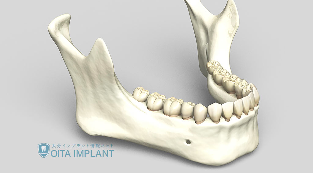 骨量が少ない場合でもインプラントを可能とする「骨造成」とは