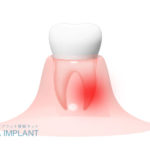 噛むと痛い「歯根膜炎」とは　