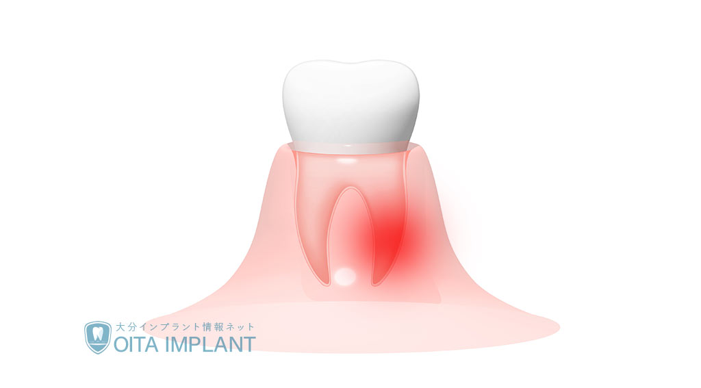 噛むと痛い「歯根膜炎」とは　