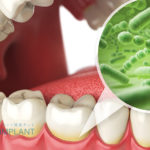 インプラント治療前に必ず治しておくべき「歯周病」　