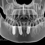 インプラントのデメリット