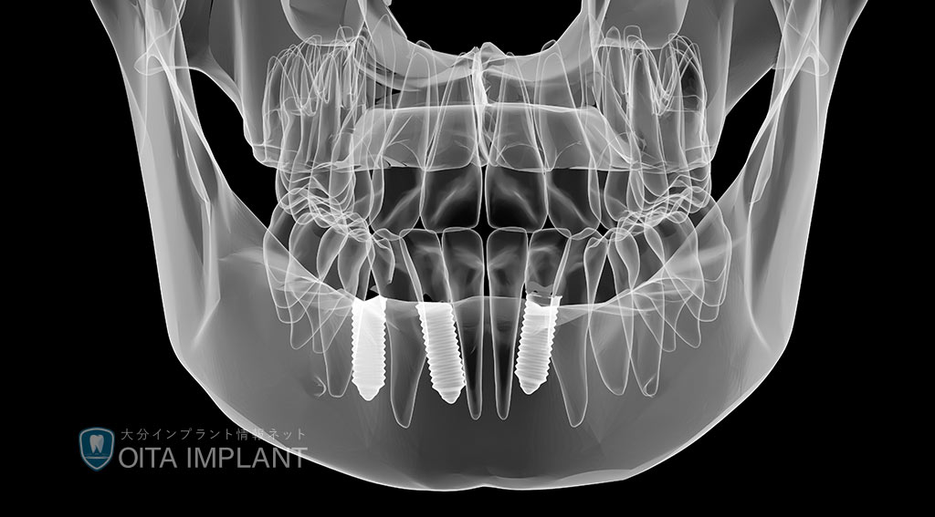 インプラントのデメリット