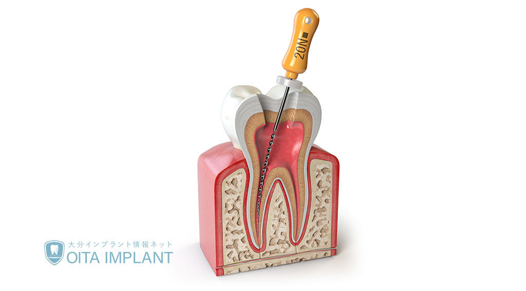 歯の根の治療「根管治療」とは